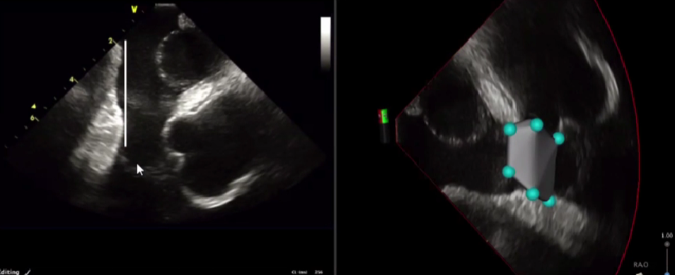 心律解码丨心房扑动的心电图特点及治疗