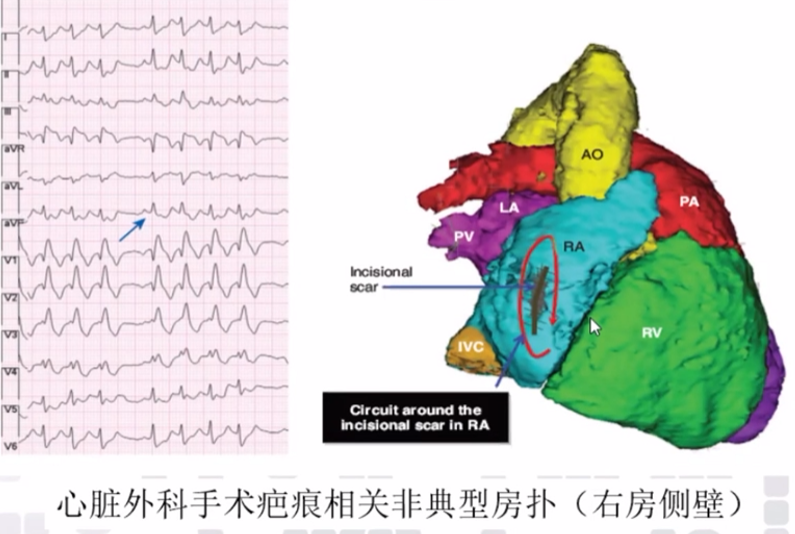 心律解码丨心房扑动的心电图特点及治疗