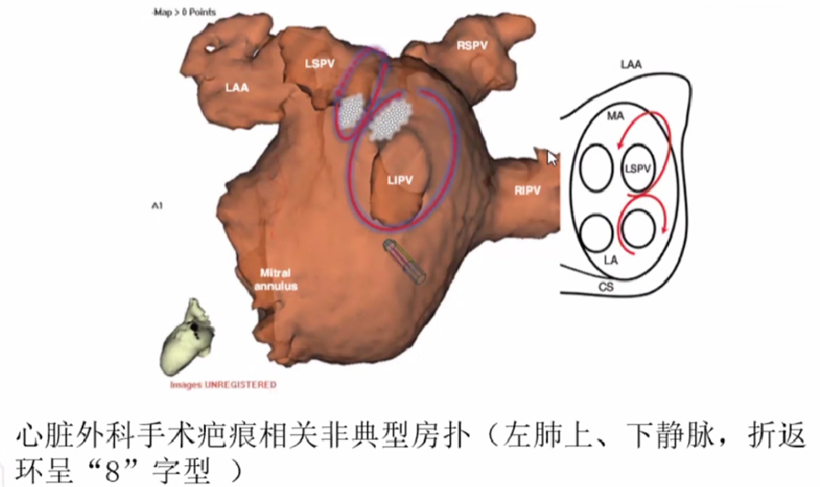 心律解码丨心房扑动的心电图特点及治疗