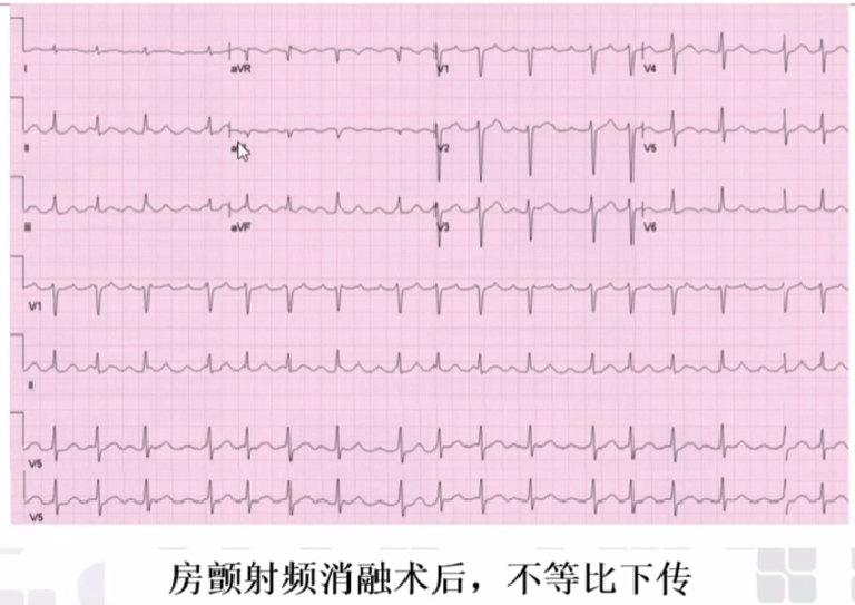 心律解码丨心房扑动的心电图特点及治疗