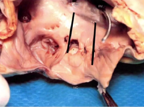 心律解码丨心房扑动的心电图特点及治疗