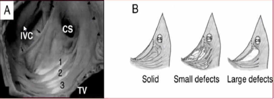 心律解码丨心房扑动的心电图特点及治疗