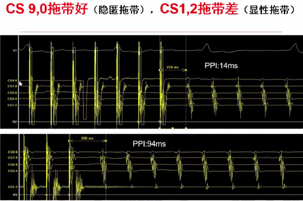 心律解码丨心房扑动的心电图特点及治疗