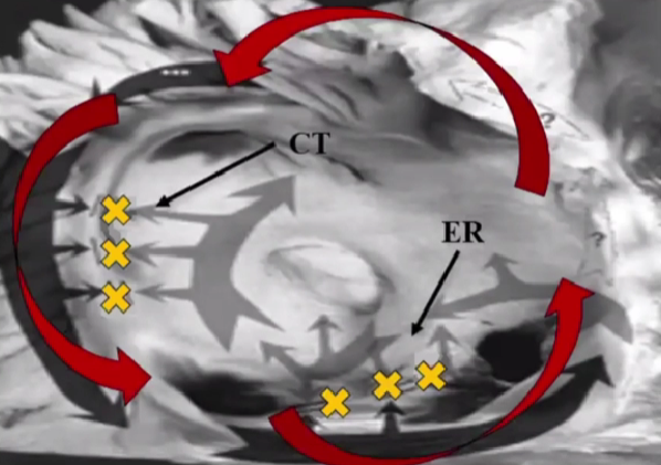 心律解码丨心房扑动的心电图特点及治疗