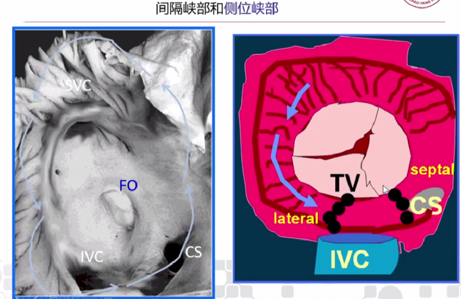 心律解码丨心房扑动的心电图特点及治疗