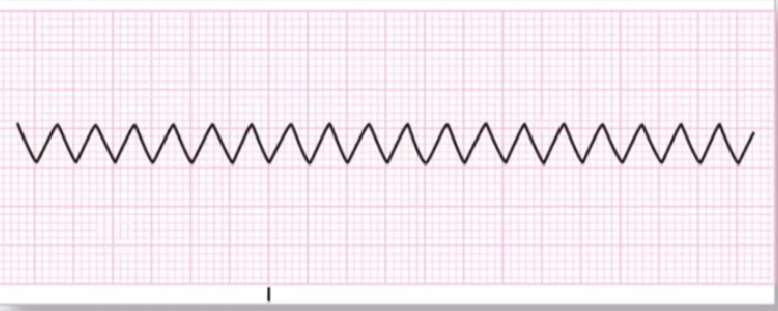 心律解码丨心房扑动的心电图特点及治疗