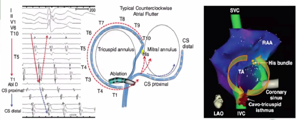 心律解码丨心房扑动的心电图特点及治疗