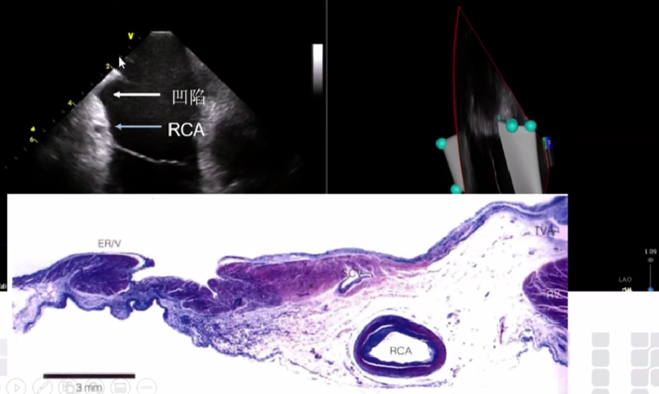 心律解码丨心房扑动的心电图特点及治疗