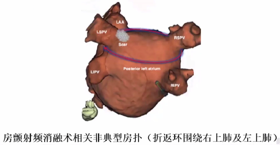 心律解码丨心房扑动的心电图特点及治疗