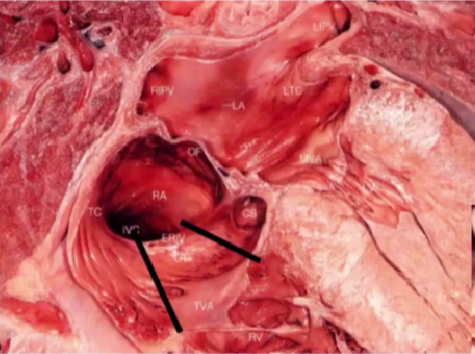 心律解码丨心房扑动的心电图特点及治疗