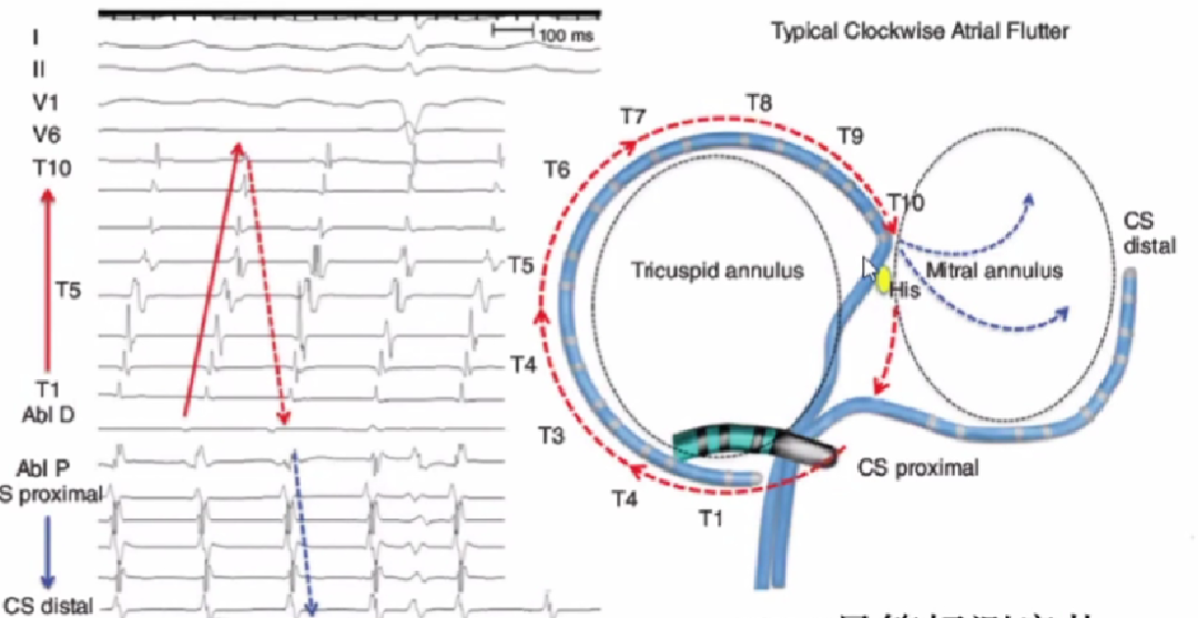 心律解码丨心房扑动的心电图特点及治疗