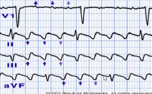 心律解码丨心房扑动的心电图特点及治疗