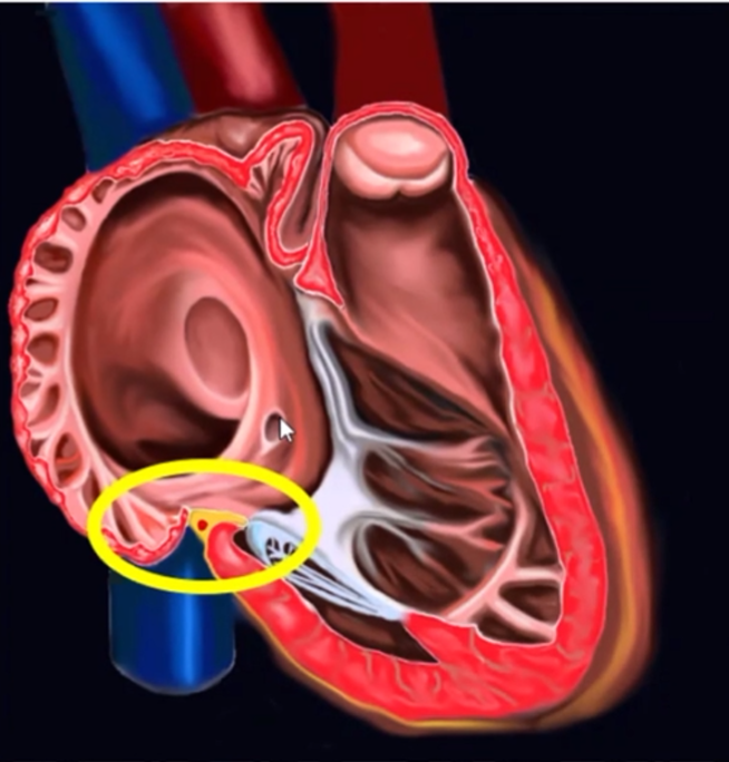 心律解码丨心房扑动的心电图特点及治疗