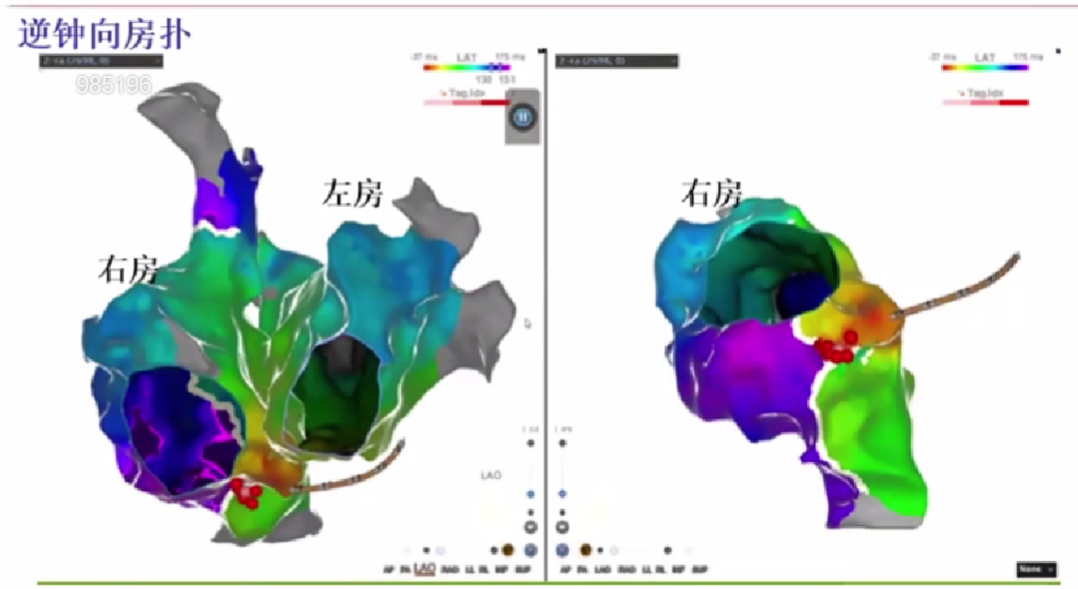 心律解码丨心房扑动的心电图特点及治疗