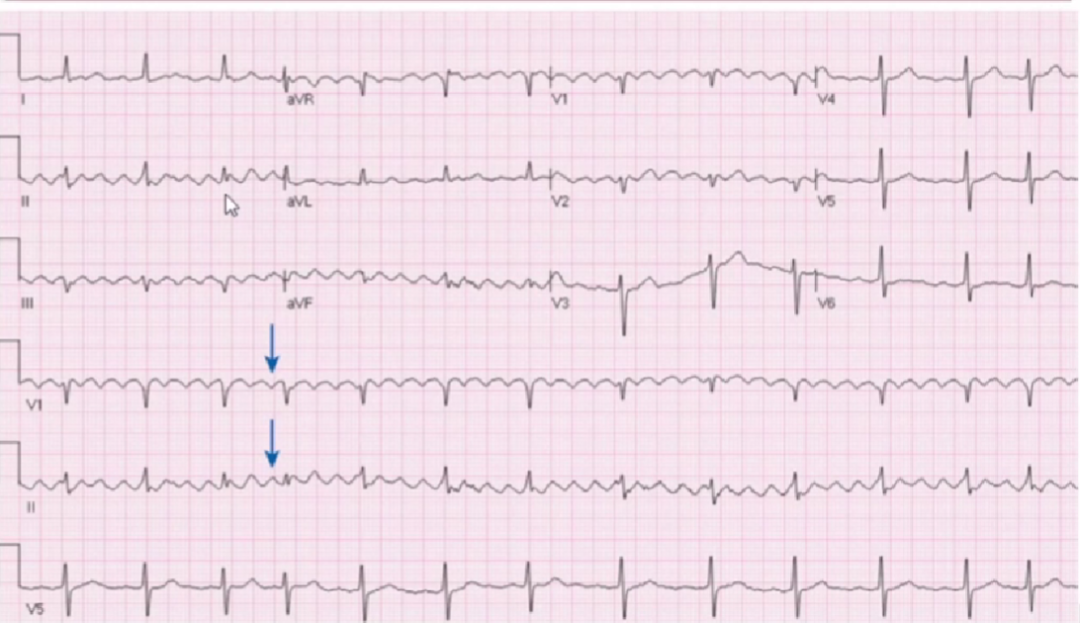 心律解码丨心房扑动的心电图特点及治疗