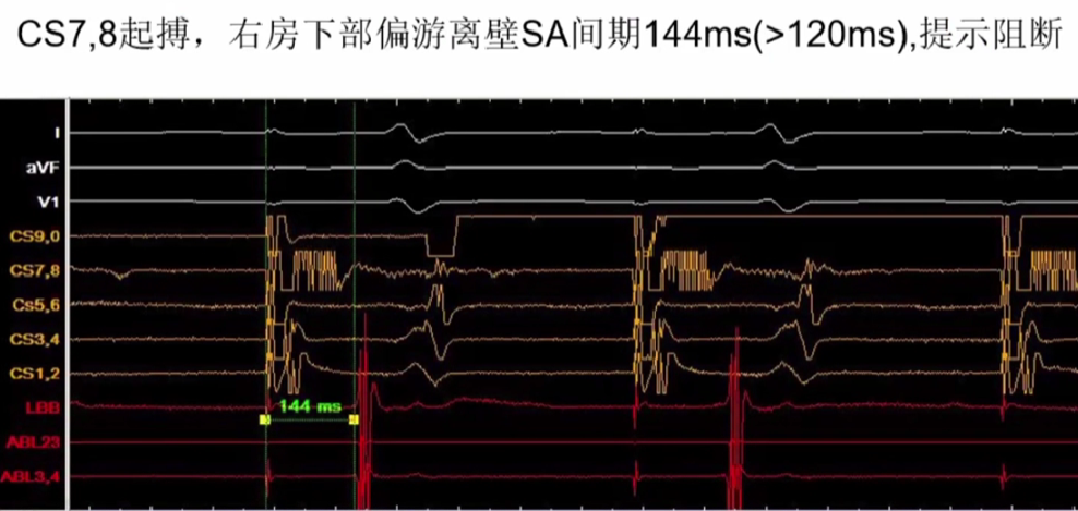 心律解码丨心房扑动的心电图特点及治疗