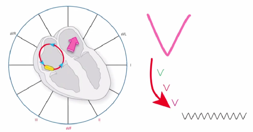心律解码丨心房扑动的心电图特点及治疗