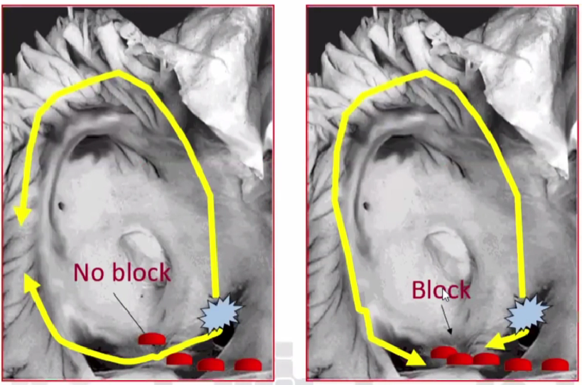 心律解码丨心房扑动的心电图特点及治疗