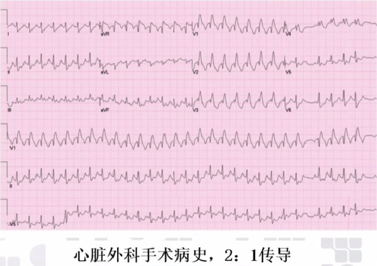 心律解码丨心房扑动的心电图特点及治疗