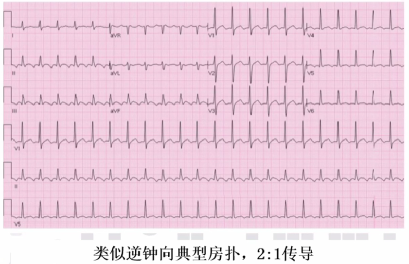 心律解码丨心房扑动的心电图特点及治疗