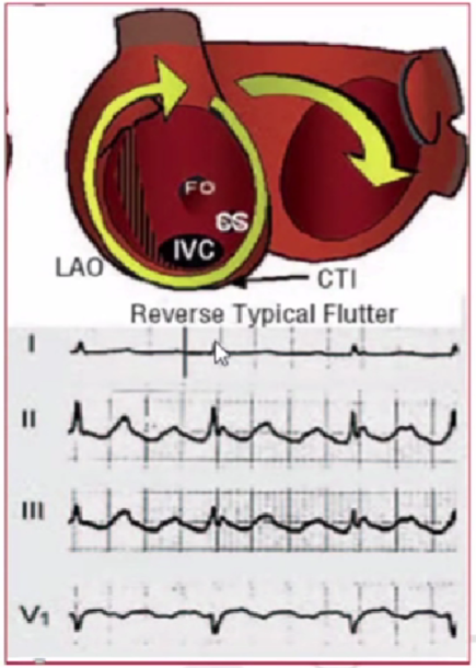心律解码丨心房扑动的心电图特点及治疗