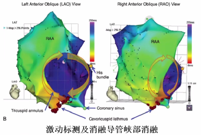 心律解码丨心房扑动的心电图特点及治疗