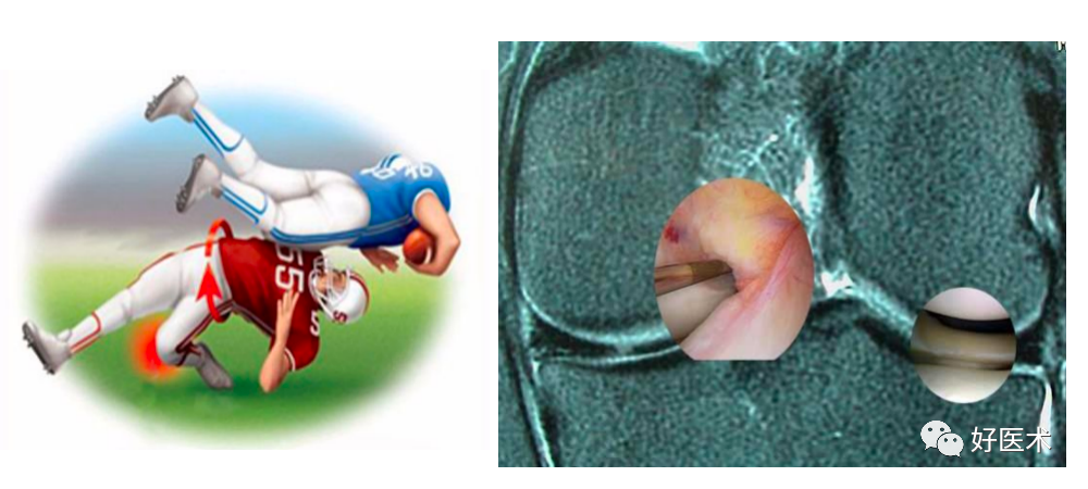 干货：高清动图学前交叉韧带MRI诊断，经典珍藏版！