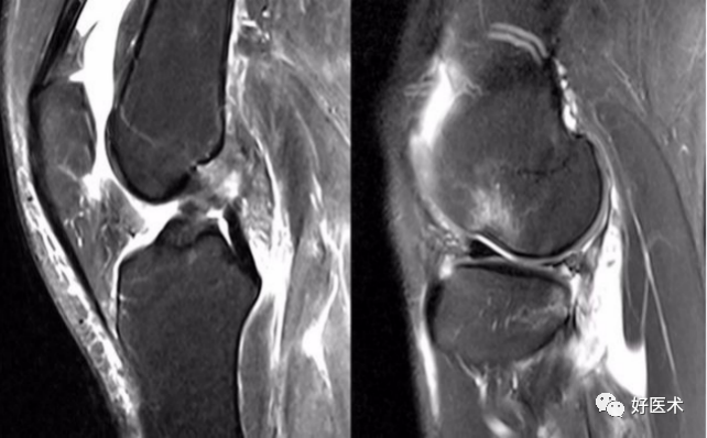 干货：高清动图学前交叉韧带MRI诊断，经典珍藏版！
