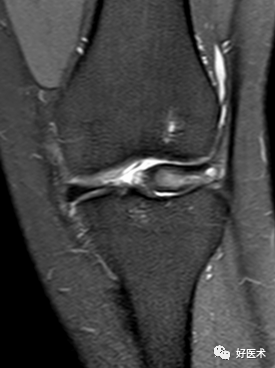 干货：高清动图学前交叉韧带MRI诊断，经典珍藏版！