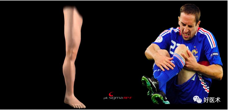 干货：高清动图学前交叉韧带MRI诊断，经典珍藏版！