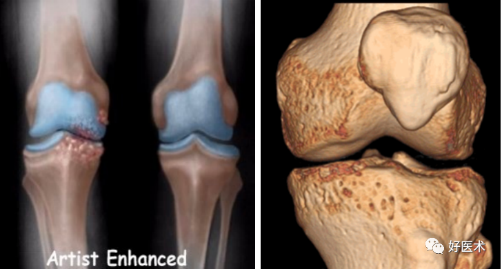 干货：高清动图学前交叉韧带MRI诊断，经典珍藏版！