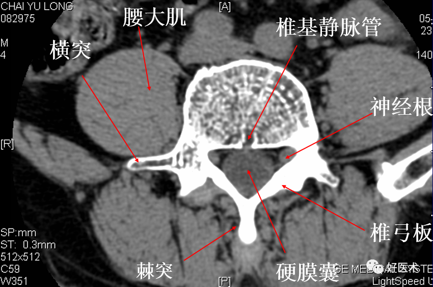 脊柱影像解剖及诊断要点_医学界-助力医生临床决策和职业成长
