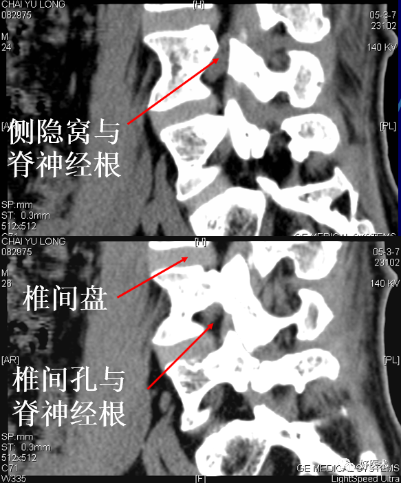 腰椎侧隐窝是椎管两侧的延伸部,是容纳脊神经的通道,当椎间盘纤维环