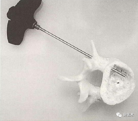 pvp手术怎么麻醉早读 ｜ 牢固掌握椎体成形术要领，看这篇文章就够了！_https://www.jmylbn.com_新闻资讯_第5张