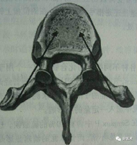 pvp手术怎么麻醉早读 ｜ 牢固掌握椎体成形术要领，看这篇文章就够了！_https://www.jmylbn.com_新闻资讯_第6张