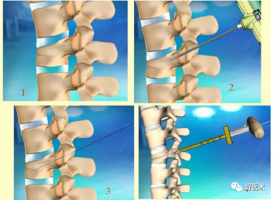pvp手术怎么麻醉早读 ｜ 牢固掌握椎体成形术要领，看这篇文章就够了！_https://www.jmylbn.com_新闻资讯_第7张