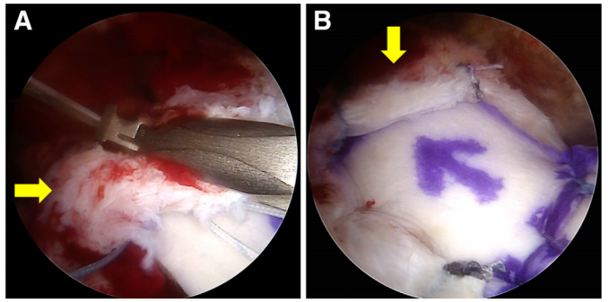 巨大不可修复性肩袖撕裂上关节囊重建新选择--脱细胞真皮基质同种异体移植物联合残余肌腱加强