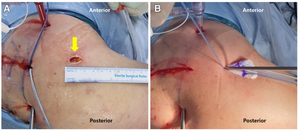 巨大不可修复性肩袖撕裂上关节囊重建新选择--脱细胞真皮基质同种异体移植物联合残余肌腱加强