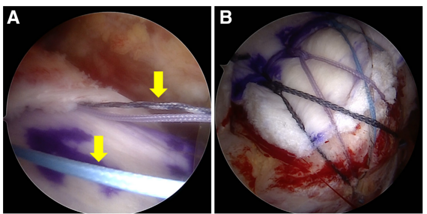 巨大不可修复性肩袖撕裂上关节囊重建新选择--脱细胞真皮基质同种异体移植物联合残余肌腱加强