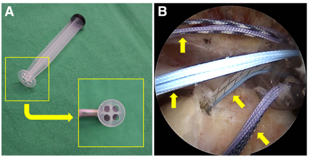 巨大不可修复性肩袖撕裂上关节囊重建新选择--脱细胞真皮基质同种异体移植物联合残余肌腱加强