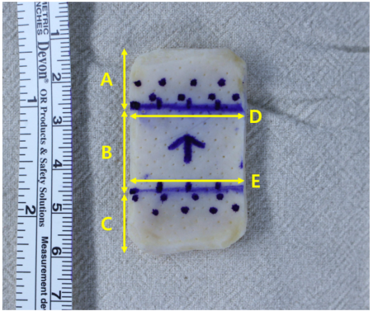 巨大不可修复性肩袖撕裂上关节囊重建新选择--脱细胞真皮基质同种异体移植物联合残余肌腱加强