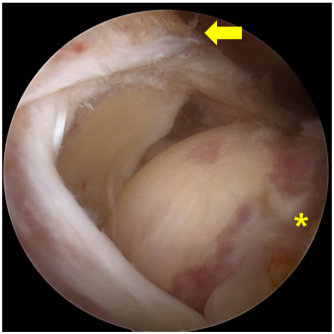 巨大不可修复性肩袖撕裂上关节囊重建新选择--脱细胞真皮基质同种异体移植物联合残余肌腱加强