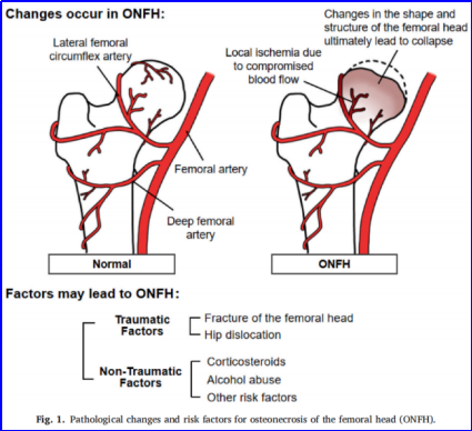 股骨头坏死保髋治疗的现状与最新进展
