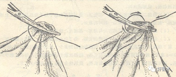 为什么要结扎血管外科手术操作 ｜ 打开手术通路之结扎止血_https://www.jmylbn.com_新闻资讯_第3张