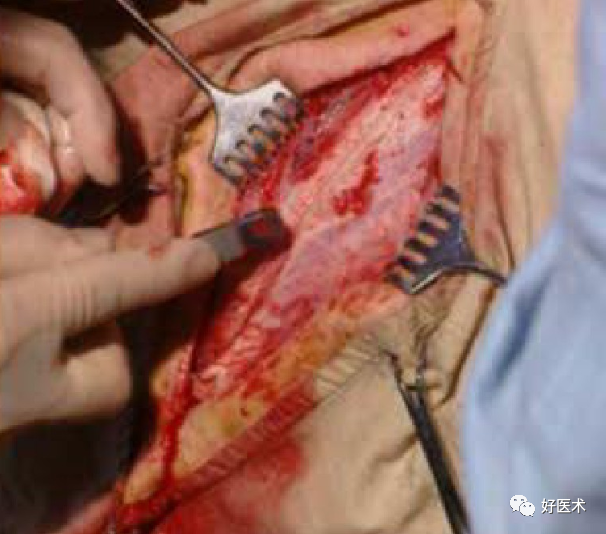 缝合时怎么持钳外科手术常用器械及其正确使用方法_https://www.jmylbn.com_新闻资讯_第21张
