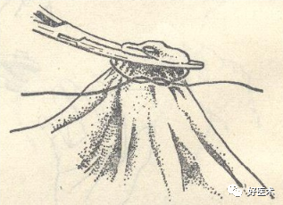 为什么要结扎血管外科手术操作 ｜ 打开手术通路之结扎止血_https://www.jmylbn.com_新闻资讯_第2张