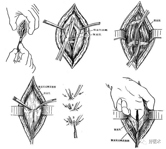 分离结扎钳怎么用【学生频道】外科手术基本功速成法，书上学不到的秘诀！（聂邯洛医师推荐）_https://www.jmylbn.com_新闻资讯_第27张