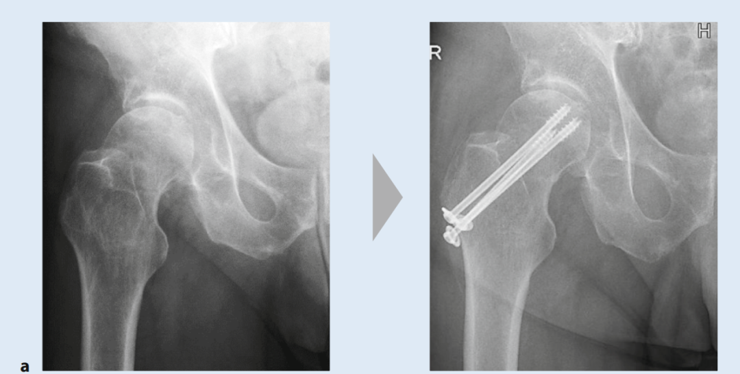 关于股骨颈骨折，你了解多少，这篇实用干货给你准备好了！