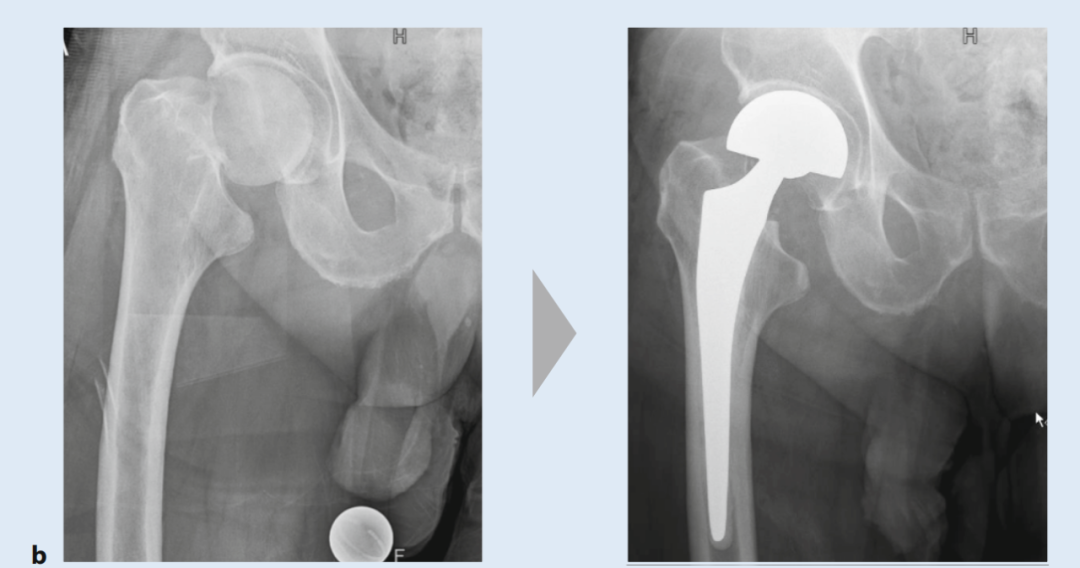 关于股骨颈骨折，你了解多少，这篇实用干货给你准备好了！
