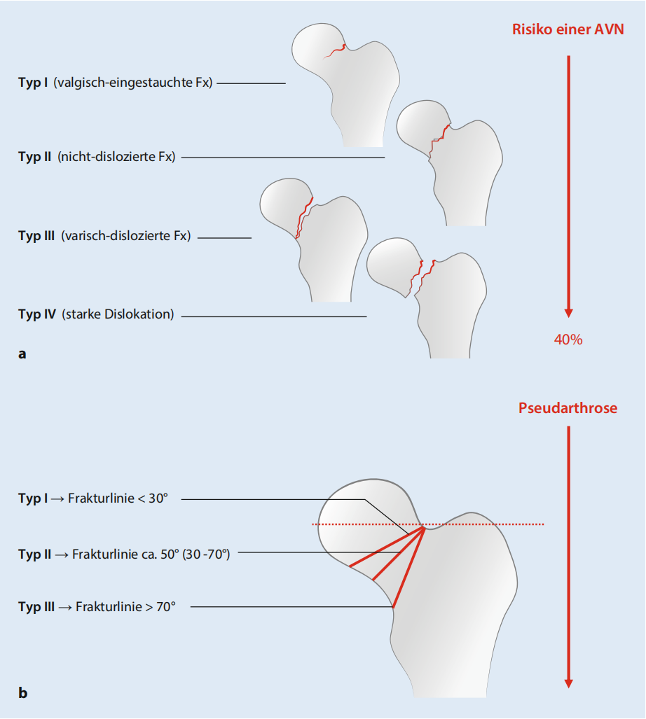 关于股骨颈骨折，你了解多少，这篇实用干货给你准备好了！